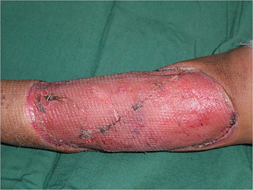 What is the name of a flesh-eating disease?